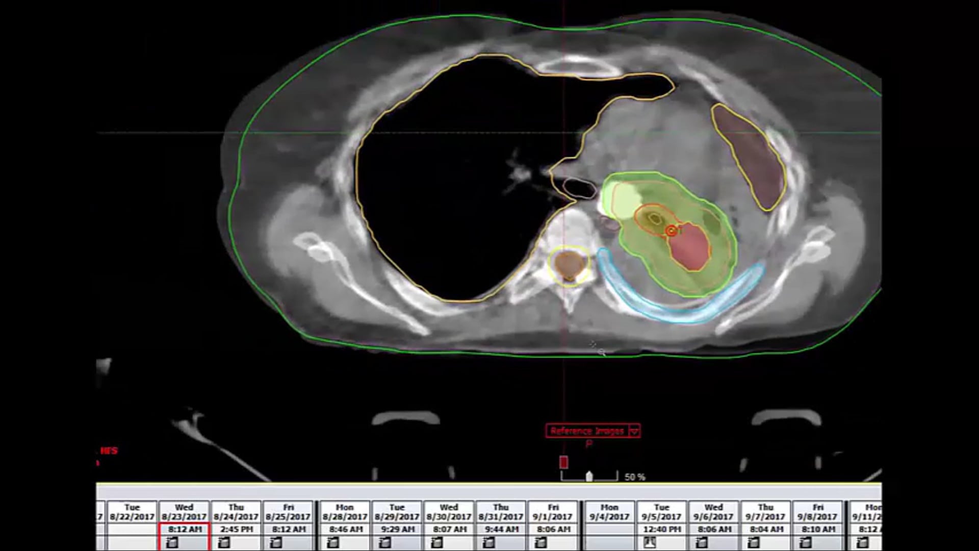 03/11/21 - Dr. Candice Johnstone - Radiation Oncology - Lung US