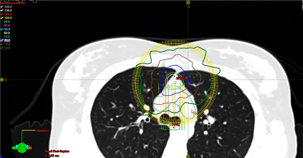 10/19/2022 - Dr. Andrea Ng - Radiation Oncology - Lymphoma