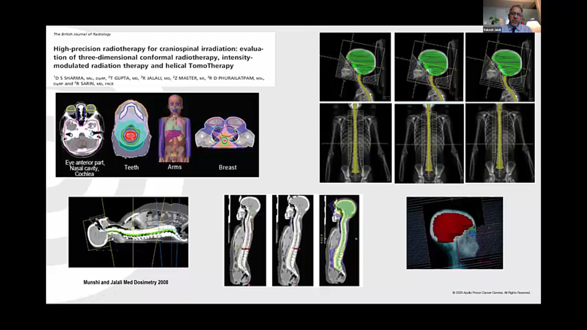 03/18/21 - Dr. Rakesh Jalali - Radiation Oncology - CNS India