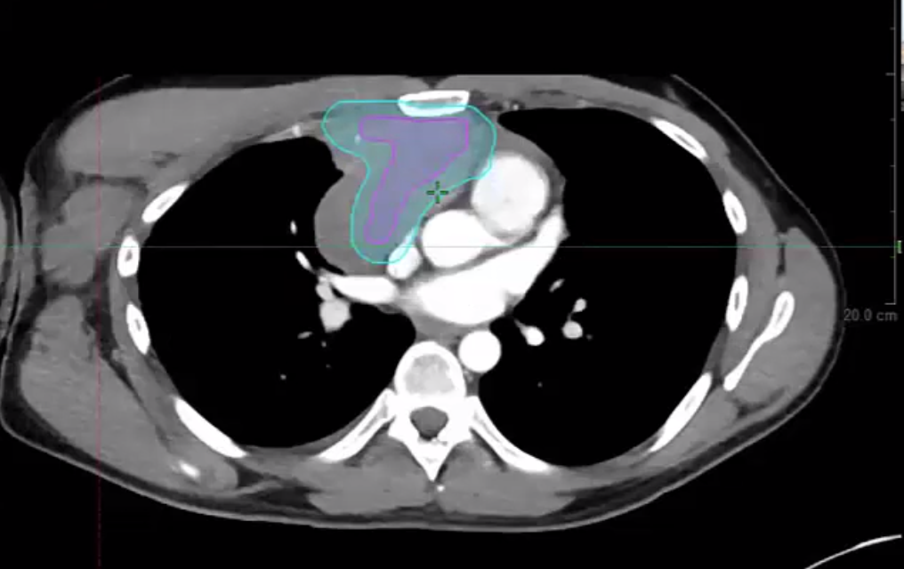 05/12/21 - Dr. Andrea Ng - Radiation Oncology - Lymphoma