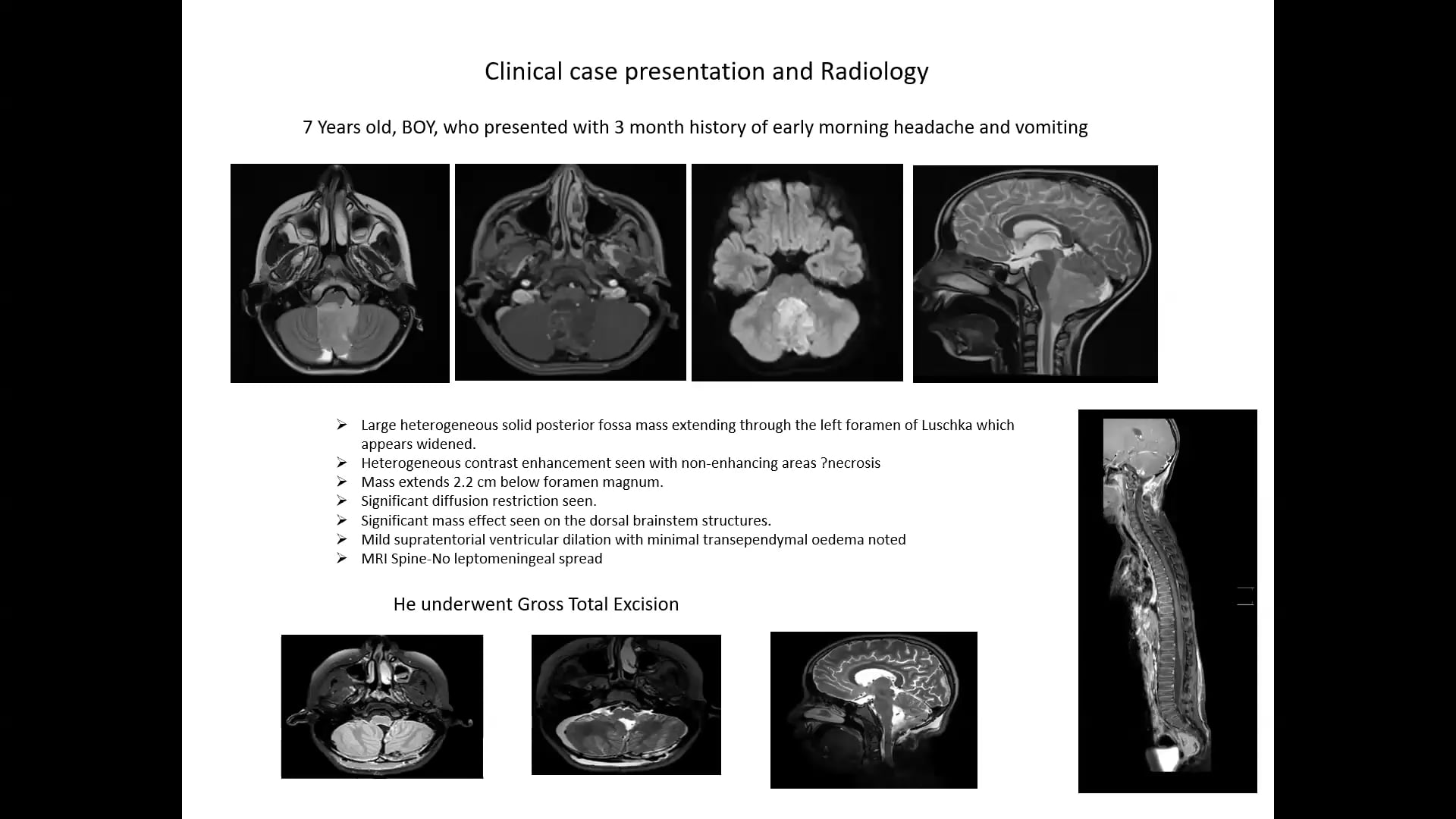 02/27/2025 - Ependymoma: Case Based Discussion, Dr. Uday Krishna