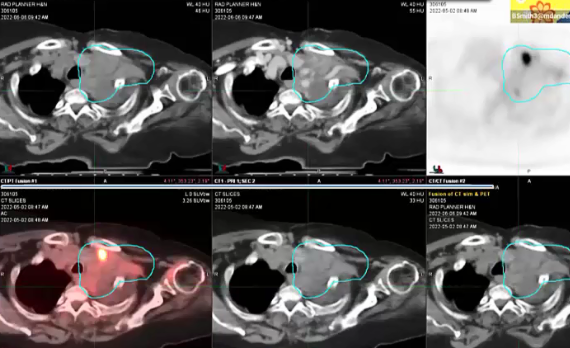 06/09/2022 - Dr. Benjamin Smith - Radiation Oncology - Breast