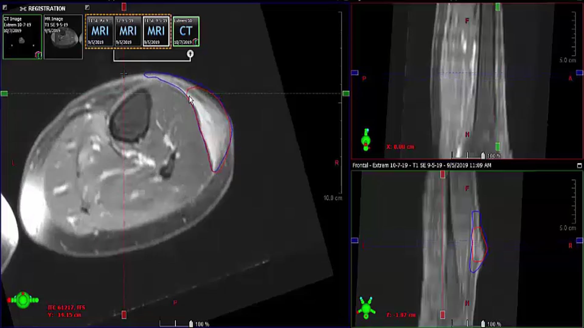 Chartrounds US - Sarcoma