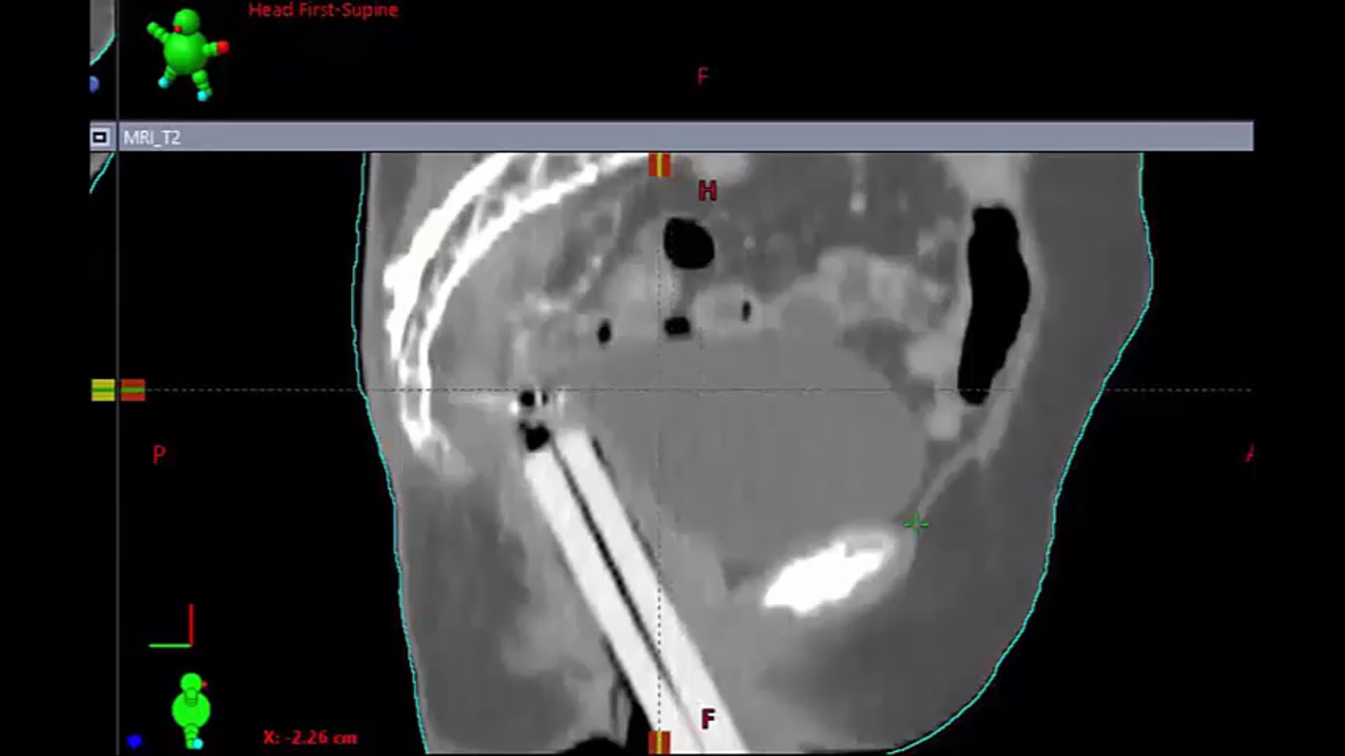 03/26/20 - Dr. Catheryn Yashar - Radiation Oncology - GYN US