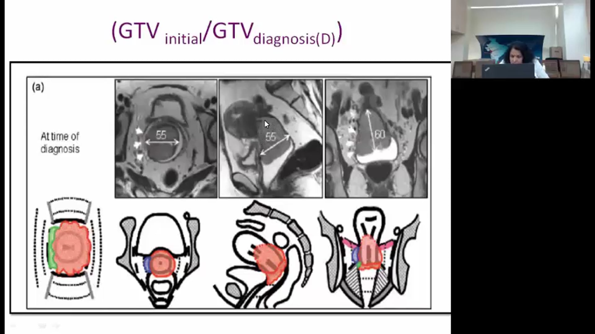 09/27/18 - Dr. Supriya Sastri (Chopra) - Radiation Oncology - GYN India
