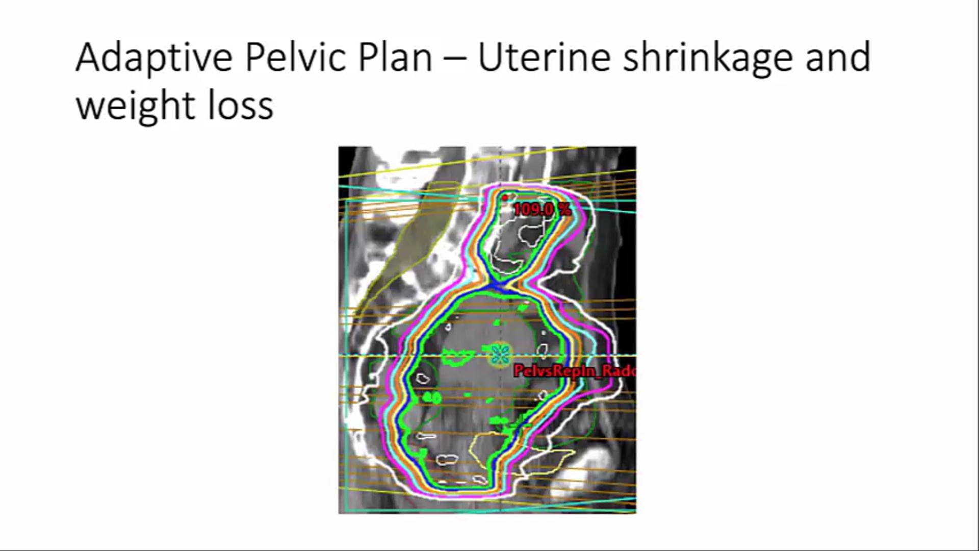 07/15/20 - Dr. Christine Fisher - Radiation Oncology - GYN US