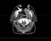 04/28/2025 - Dr. David Sher - Radiation Oncology - Head & Neck