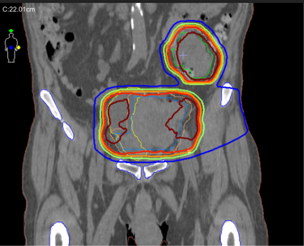 10/07/2021 - Dr. Candice Johnstone - Radiation Oncology - US Palliative