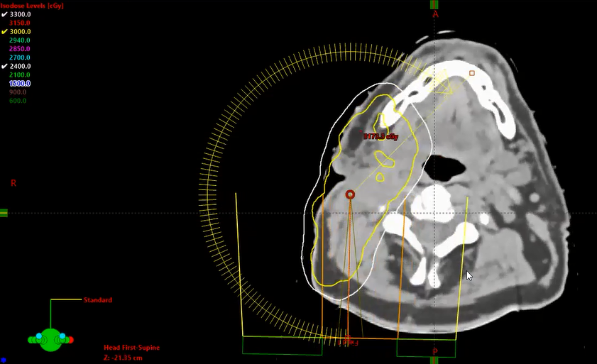 07/26/2021 - Dr. David Sher - Radiation Oncology - US H&N