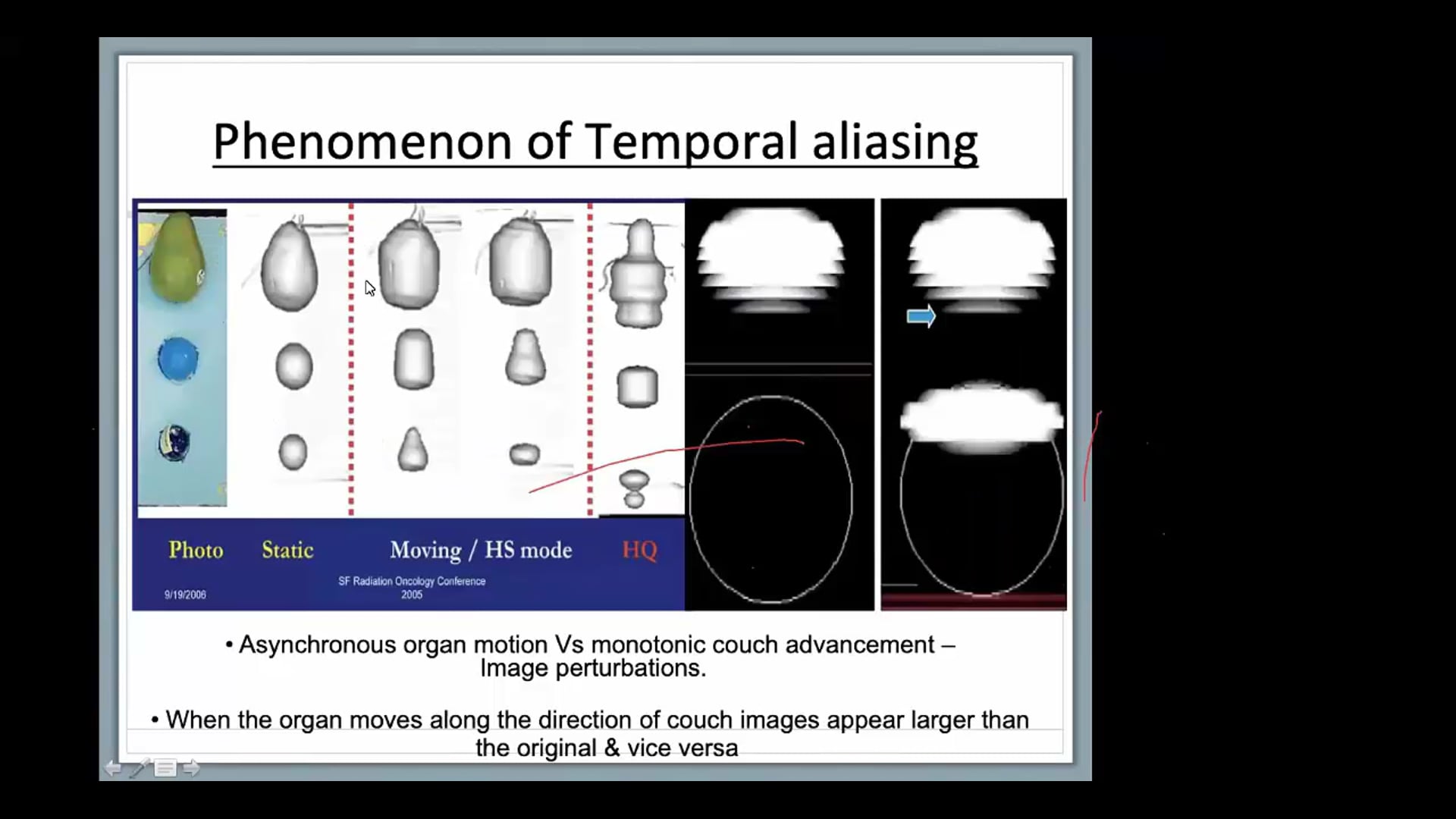 Dr. Srinivas Chilukuri - Radiation Oncology - SBRT India