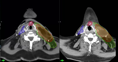 10/28/2024 - Dr. David Sher - Radiation Oncology - Head and Neck