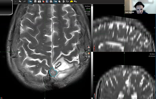 09/26/2023 - Dr. Zabi Wardak - Radiation Oncology - SBRT & CNS