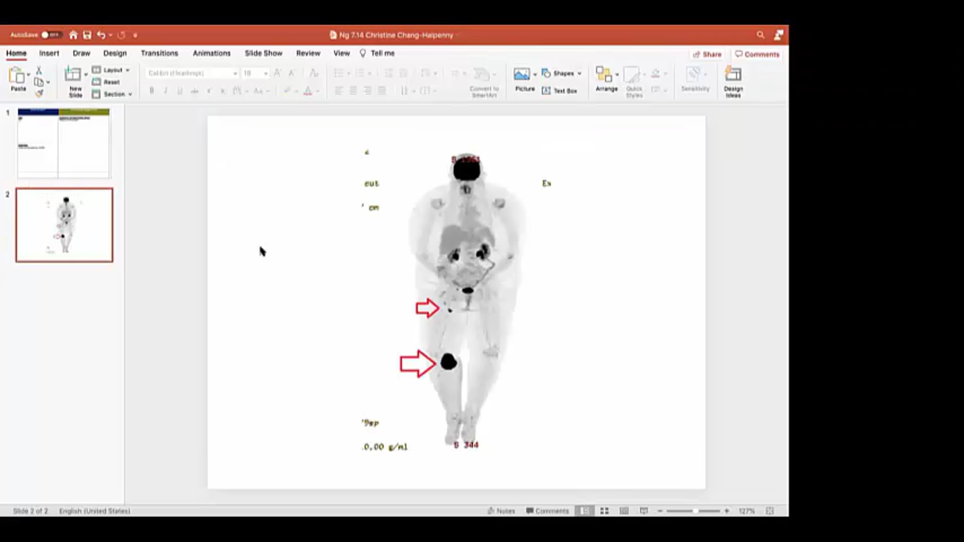 07/14/2021 - Dr. Andrea Ng - Radiation Oncology - US Lymphoma
