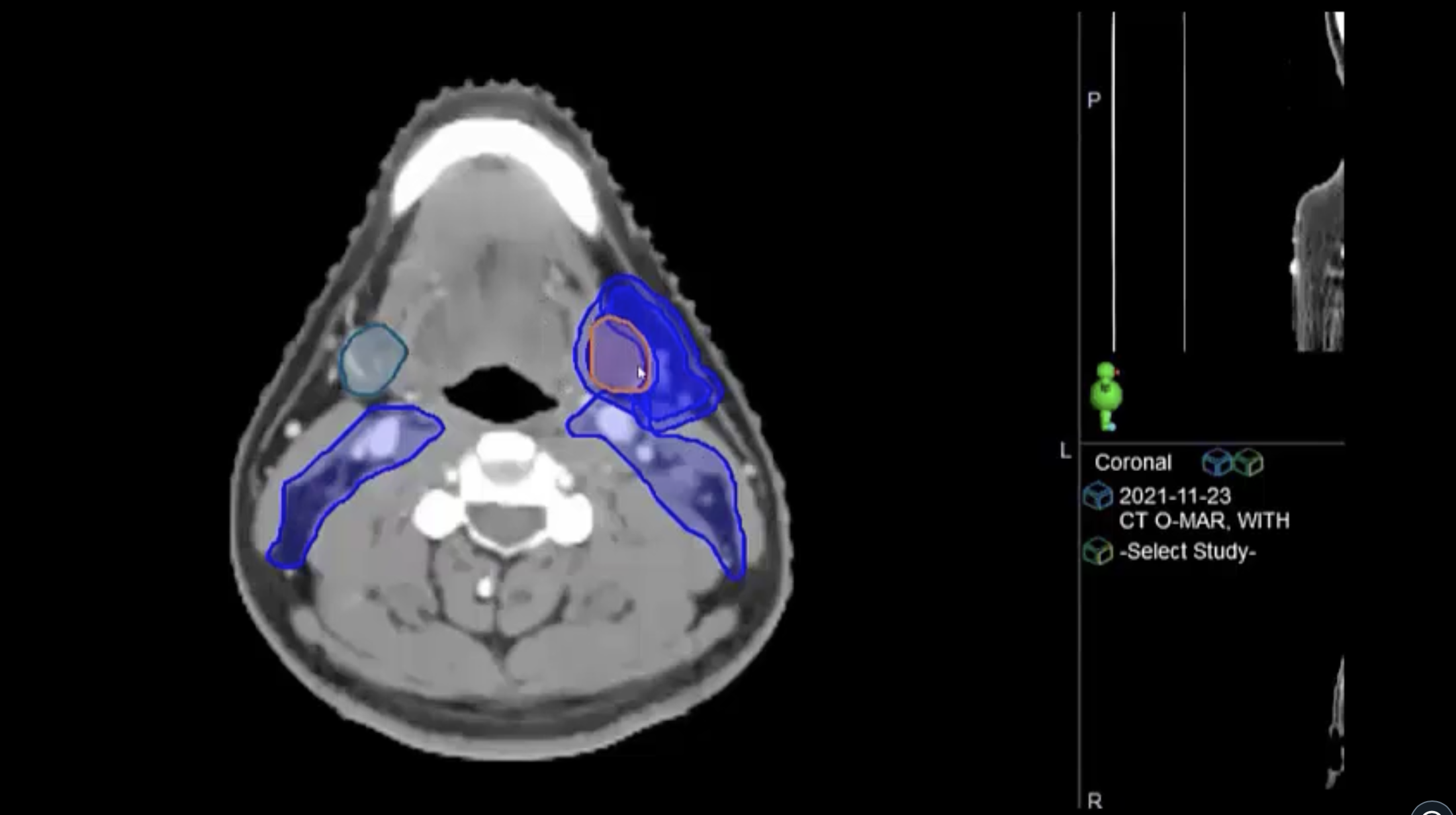 Head & Neck Contouring