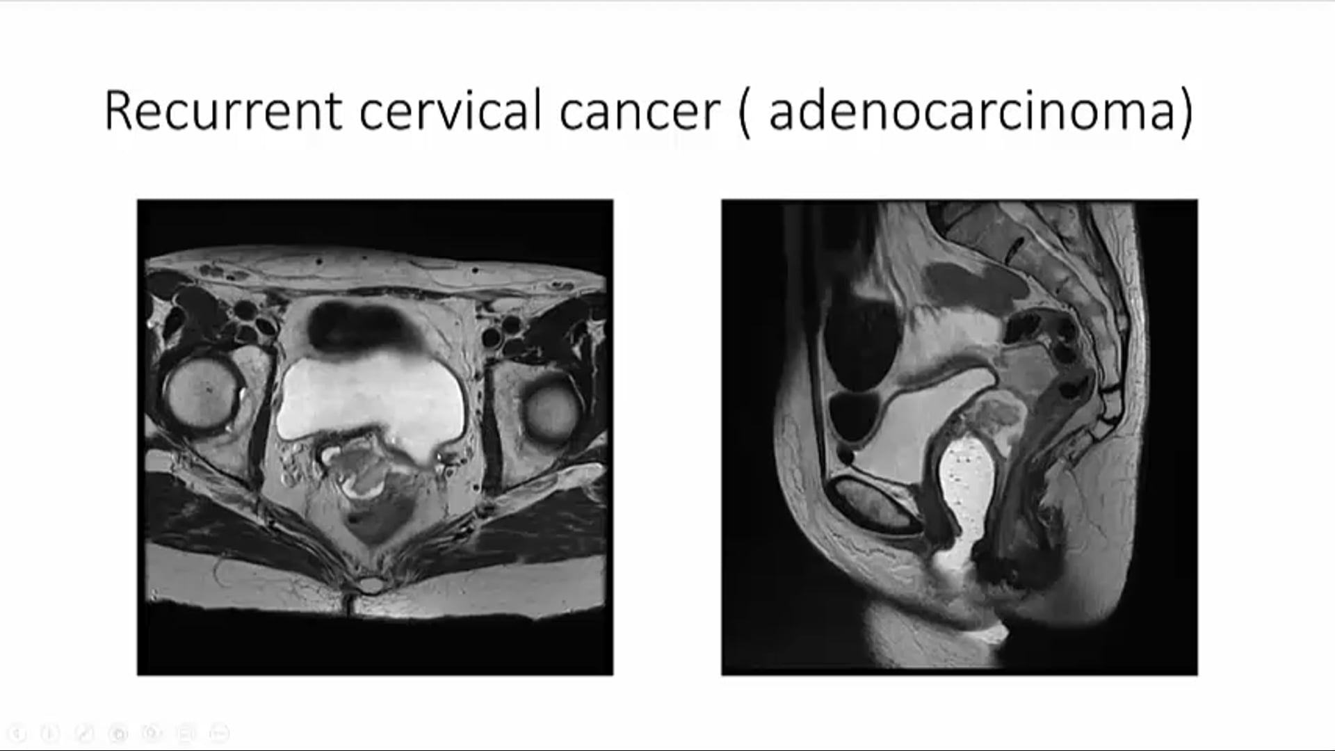 8/20/2020 - Dr. Sushil Beriwal - Radiation Oncology - GYN Brachytherapy