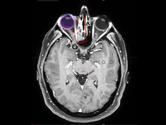 04/25/2020 - Dr. David Sher - Radiation Oncology - Head and Neck