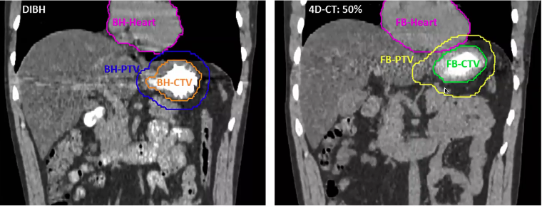 06/13/2025 - Dr. Chirayu Patel - Radiation Oncology - Lymphoma