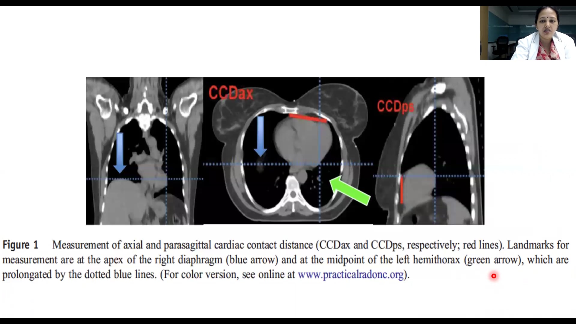 08/16/18 - Dr. Vineeta Goel - Radiation Oncology - Breast India