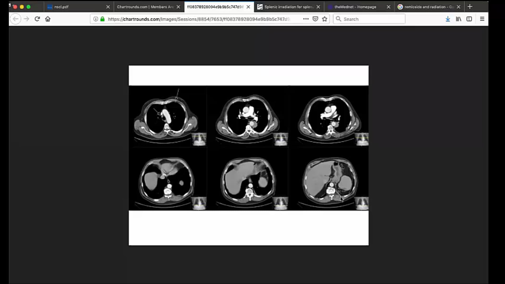 03/13/19 - Dr. Kenneth Rosenzweig - Radiation Oncology - Lung US