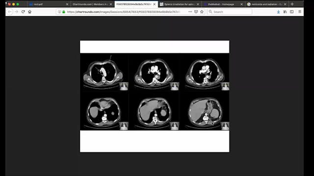 03/13/19 - Dr. Kenneth Rosenzweig - R...