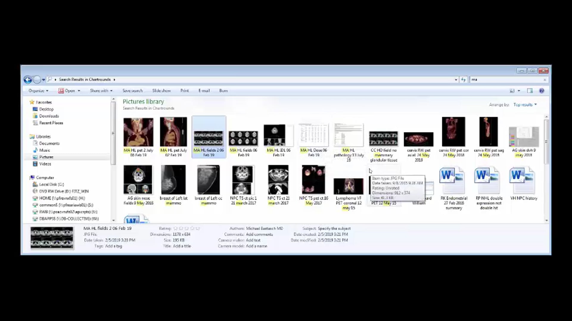 02/06/19 - Dr. Andrea Ng - Radiation Oncology - Lymphoma US