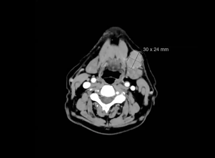 02/26/2024 - Dr. David Sher - Radiation Oncology - Head & Neck