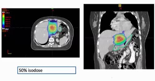 10/27/2022 - Dr. Vineeta Goel - Radiation Oncology - India SBRT