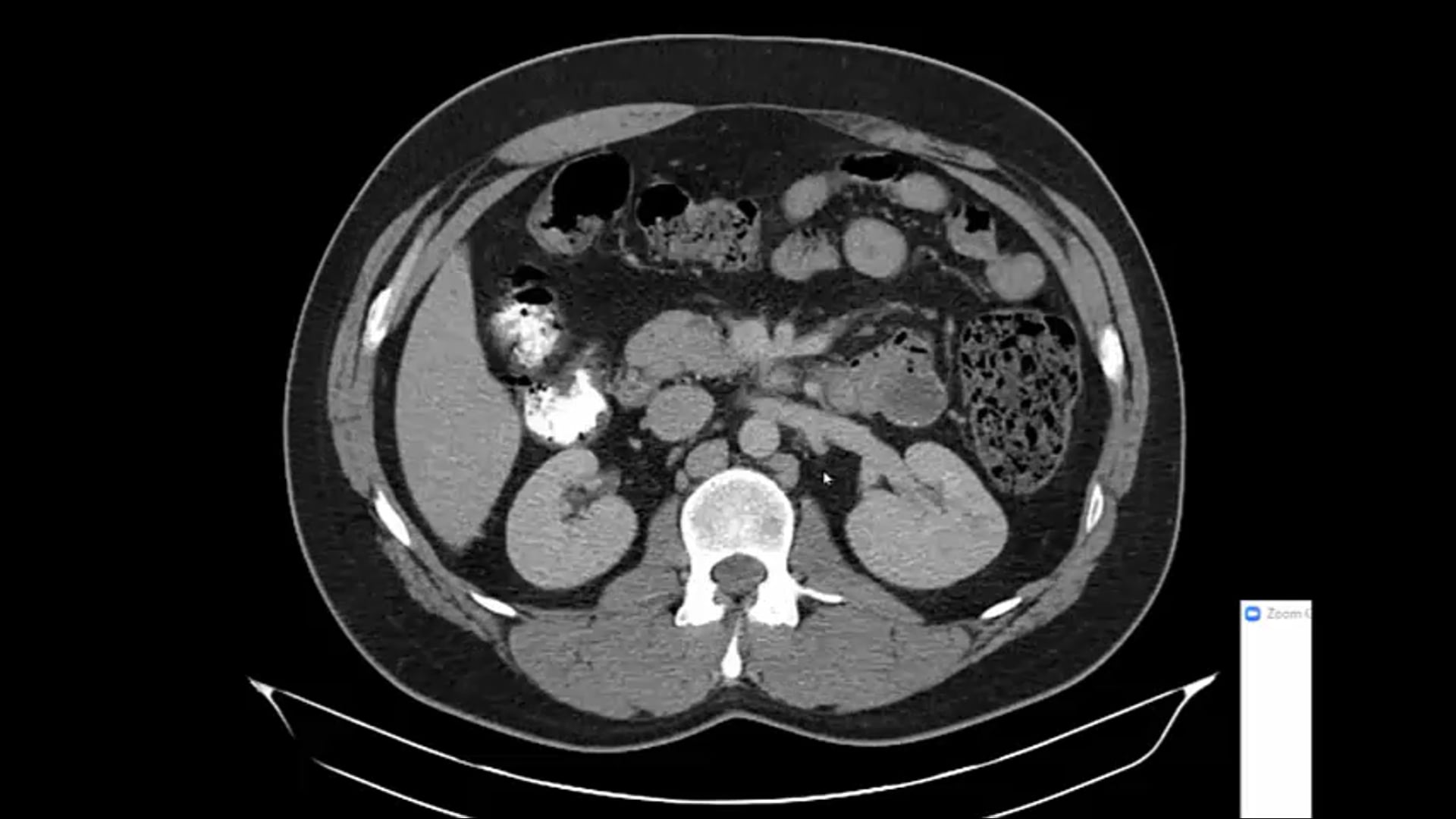 02/16/21 - Dr. Howard Sandler - Radiation Oncology - GU US