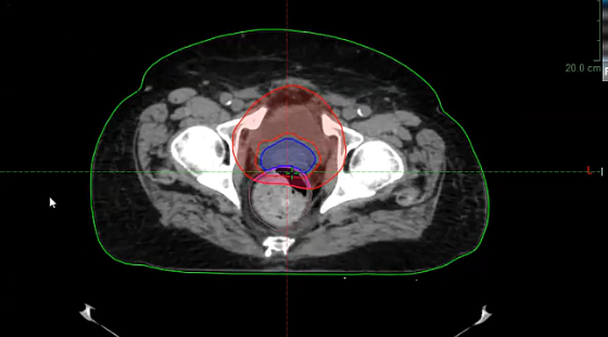 06/23/2022 - Dr. Ronald Chen - Radiation Oncology - GU