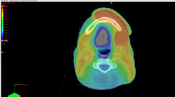 04/29/2024 - Dr. David Sher - Radiation Oncology - Head & Neck