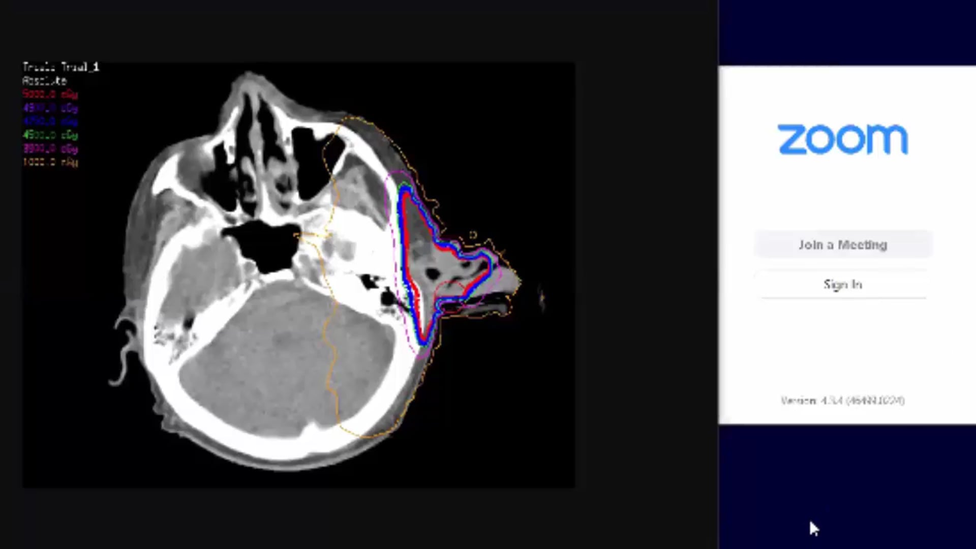 03/08/19 - Dr. Kenneth Hu - Radiation Oncology - Head and Neck US
