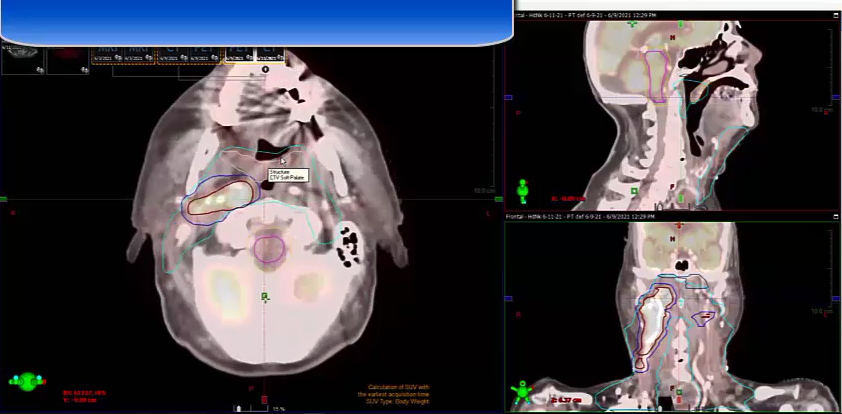 06/15/2021 - Dr. Kenneth Hu - Radiation Oncology - Head and Neck