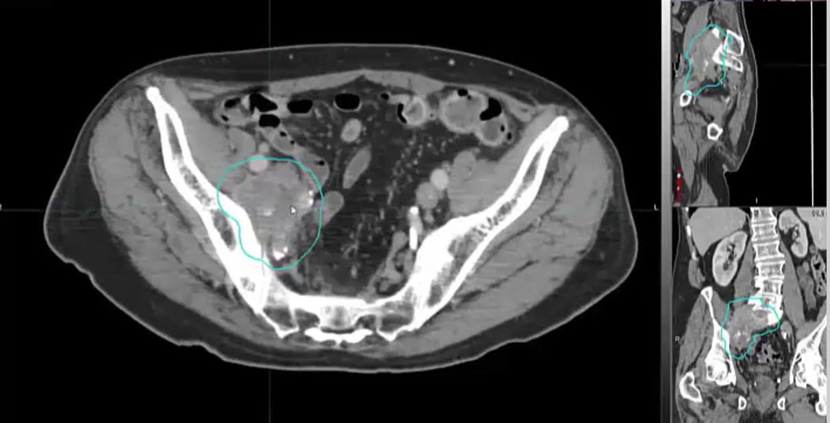 05/26/2022 - Dr. Ronald Chen - Radiation Oncology - GU