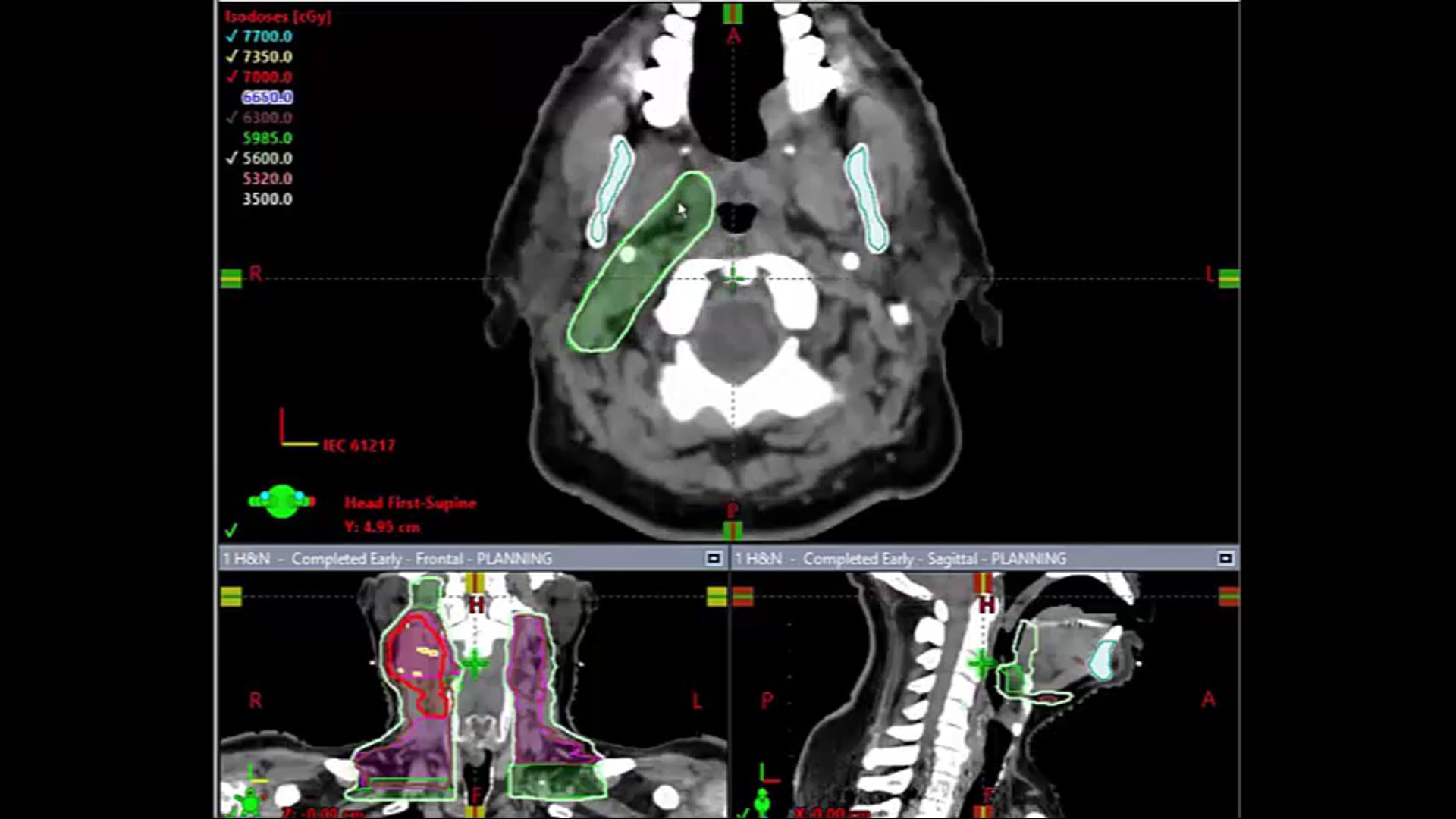 03/09/21- Dr. Kenneth Hu - Radiation Oncology - Head and Neck US