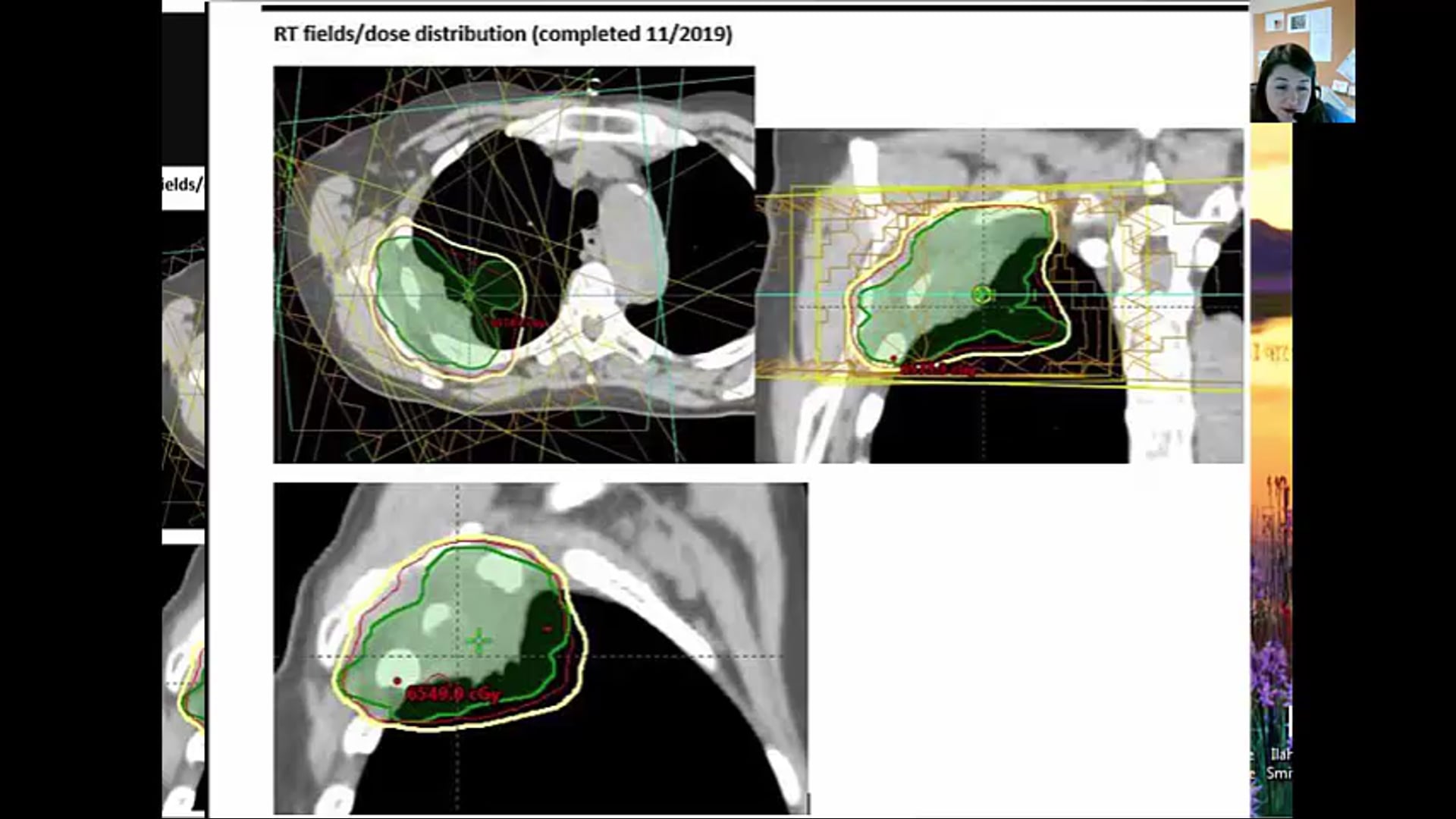 06/03/2021 - Dr. Candace Johnstone - Radiation Oncology - Palliative