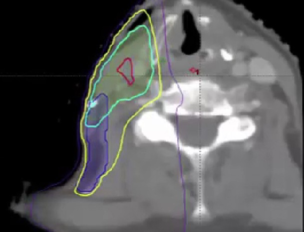 09/08/2025 - Dr. David Sher - Radiation Oncology - Head & Neck