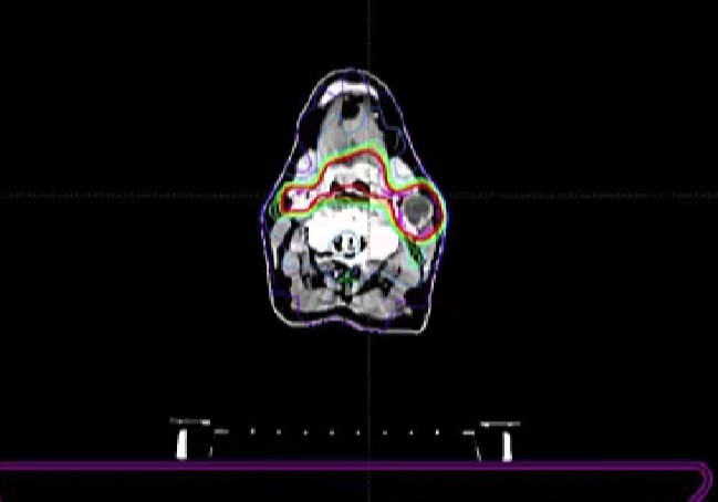 11/24/2025 - Dr. David Sher - Radiation Oncology - Head & Neck