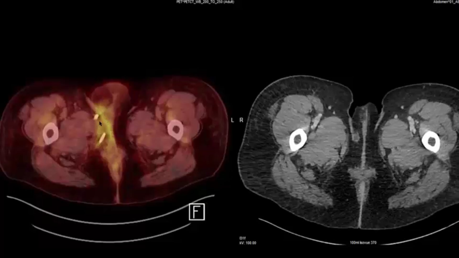 11/13/19 - Dr. Harvey Mamon - Radiation Oncology - GI US