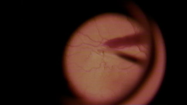 Swimming to the Macula OTTID:460522