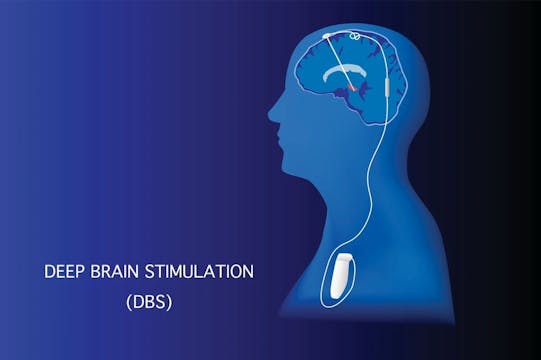 DBS: A Patient's Point of View