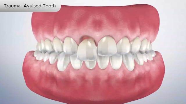 Trauma- Avulsed Tooth - Dental Patient Education Video