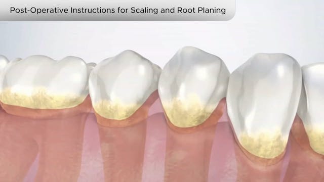 Post-Operative for Scaling and Root Planing - Dental Patient Education Video