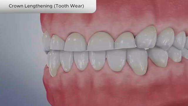 Crown Lengthening (Tooth Wear) - Dental Patient Education Video