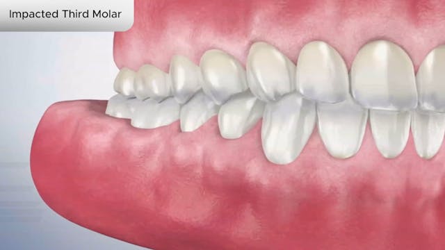 Impacted Third Molar - Dental Patient Education Video