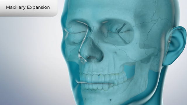 Maxillary Expansion - Dental Patient Education Video