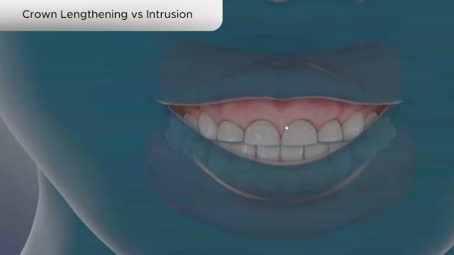 Crown Lengthening vs Intrusion - Dental Patient Education Video