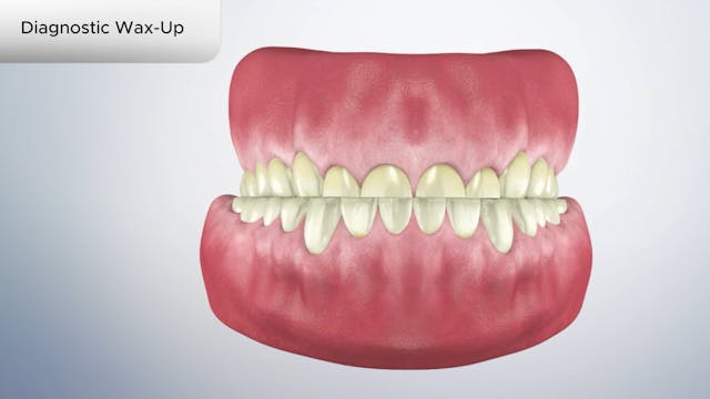 Diagnostic Wax-Up - Dental Patient Education Video