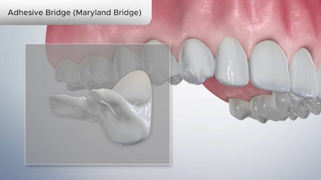 Adhesive Bridge (Maryland Bridge) - Dental Patient Education Video