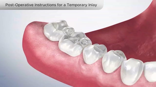 Post-Operative Instructions for Temporary Inlay - Dental Patient Education Video