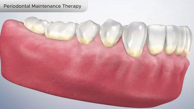 Periodontal Maintenance Therapy - Dental Patient Education Video